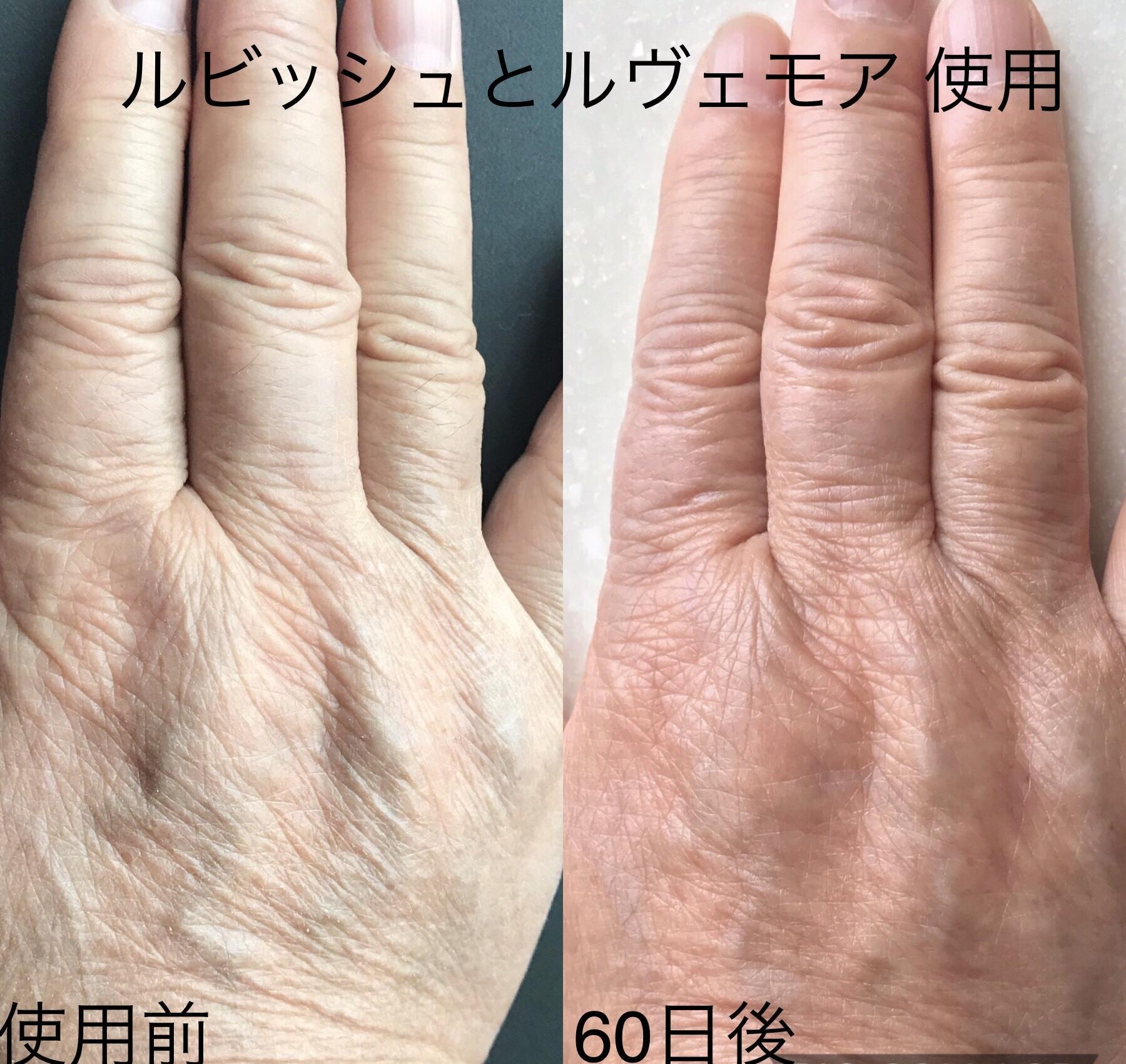 照射とホームケアを続けて